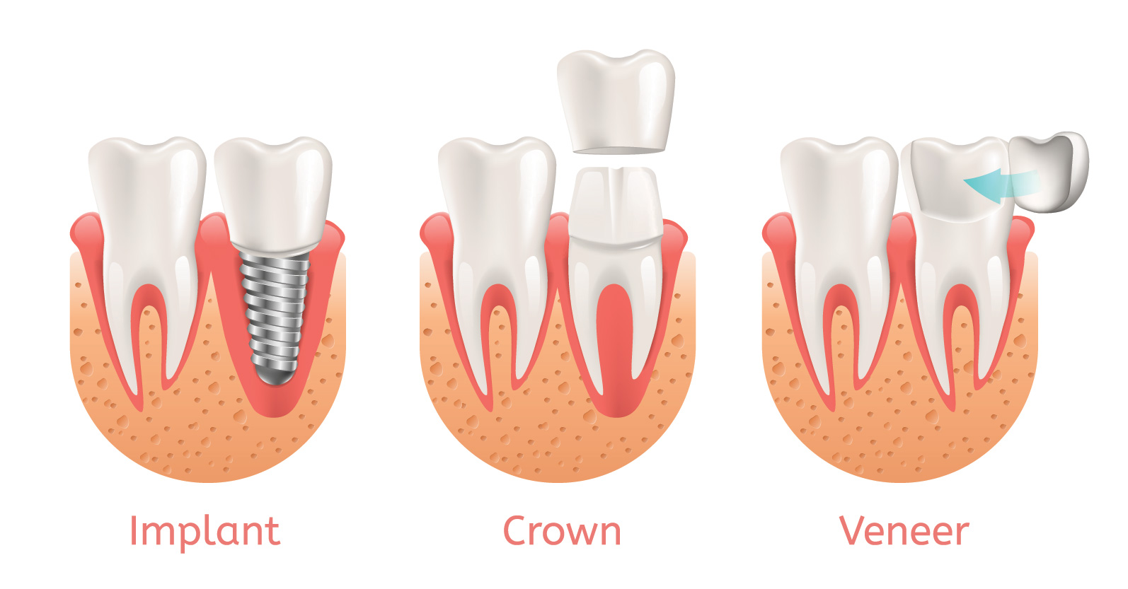 Crown vs veneer vs implant