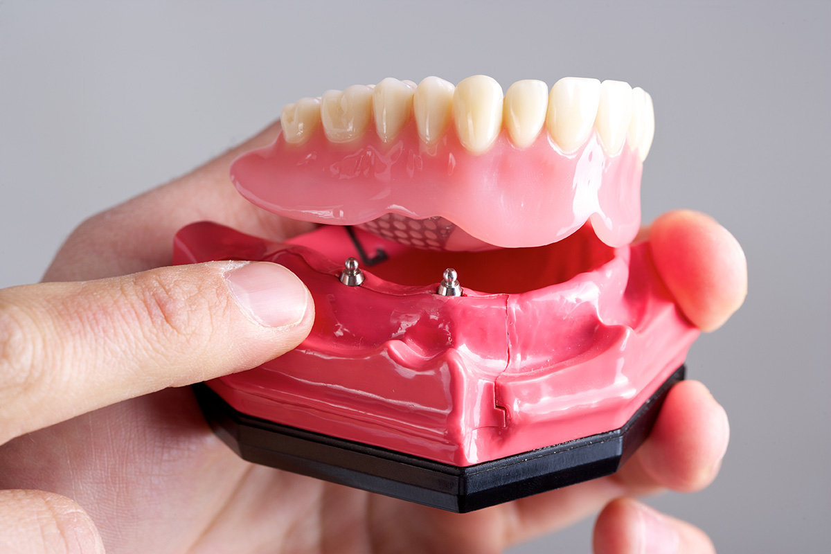 Tulip Dental Implants and Dentures