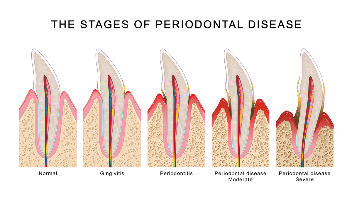 Tulip Dental Periodontal Disease